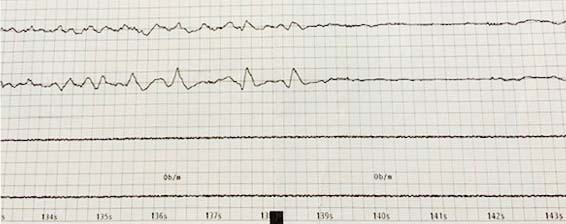 Brain activity from an unnamed ECT patient is recorded and printed out onto a chart for doctors to review. The induced seizure is represented by the spikes in the horizontal lines.